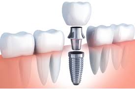 Dental Implants Yonkers